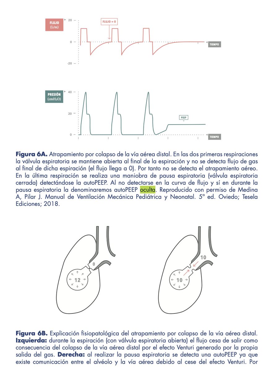 Concepto de PEEP oculta en patología obstructiva y motivo por el que es necesario tener en cuenta el posible colapso de bronquiolos de pequeño tamaño en la selección de PEEP adecuada (para garantizar el mayor vaciado pulmonar en espiración)
#SoMe4MV
