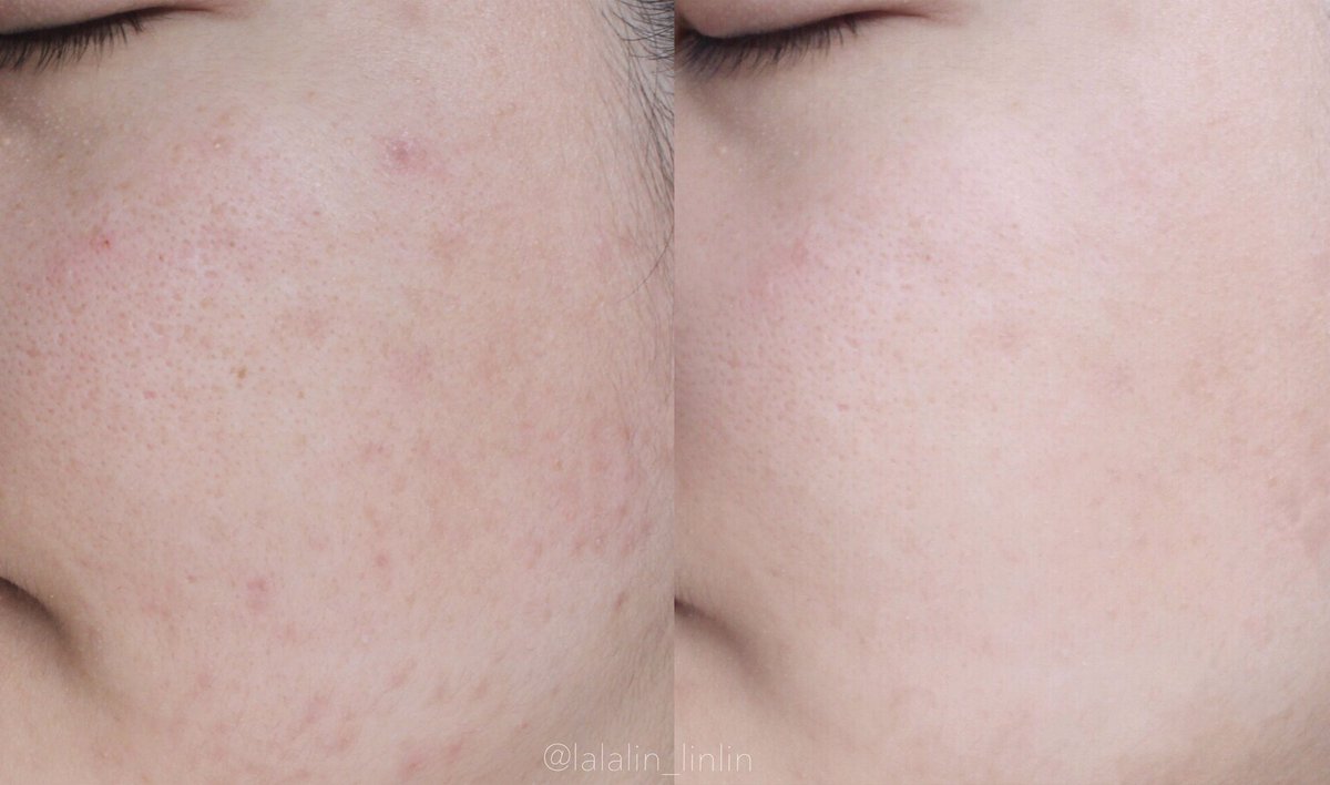 ตัวดังของจริง!!! #Skinsista ครีมซองที่ใช้แล้วชอบมาก ช่วยลดสิวอุดตัน กระชับรูขุมขน เค้าเพิ่มปริมาณอีก25% แถมสูตรใหม่มีป้องกันผิวจากมลภาวะPM 2.5 อีก ตัวนี้อ่อนโยนมาก ผิวแพ้ง่ายใช้ได้ นี่ใช้ไปประมาณ4ซองแน้วว ผิวคือดีขึ้นจนคนข้างๆทัก ไม่ตุนได้ไง #SSHonestReview #รีวิวรูขุมขนกว้าง