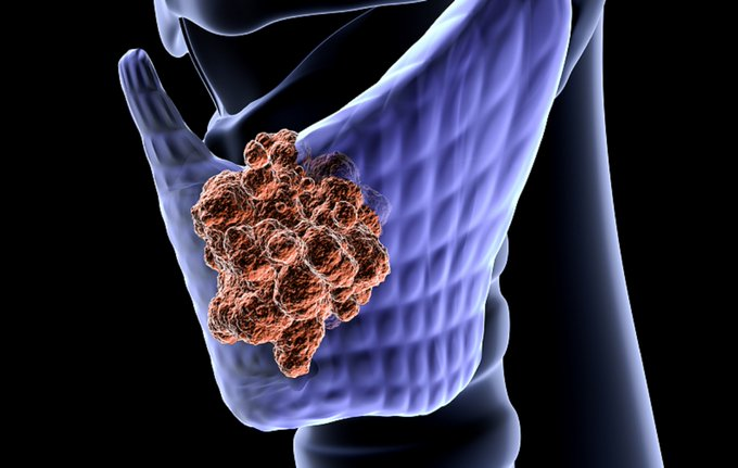 ThyroidTherapy's tweet photo. #Cardiovascular Disease in Patients With #Thyroid Cancer and High #Cholesterol
for more details:https://t.co/YTFWIRCwyV https://t.co/aNDiUyaIwT