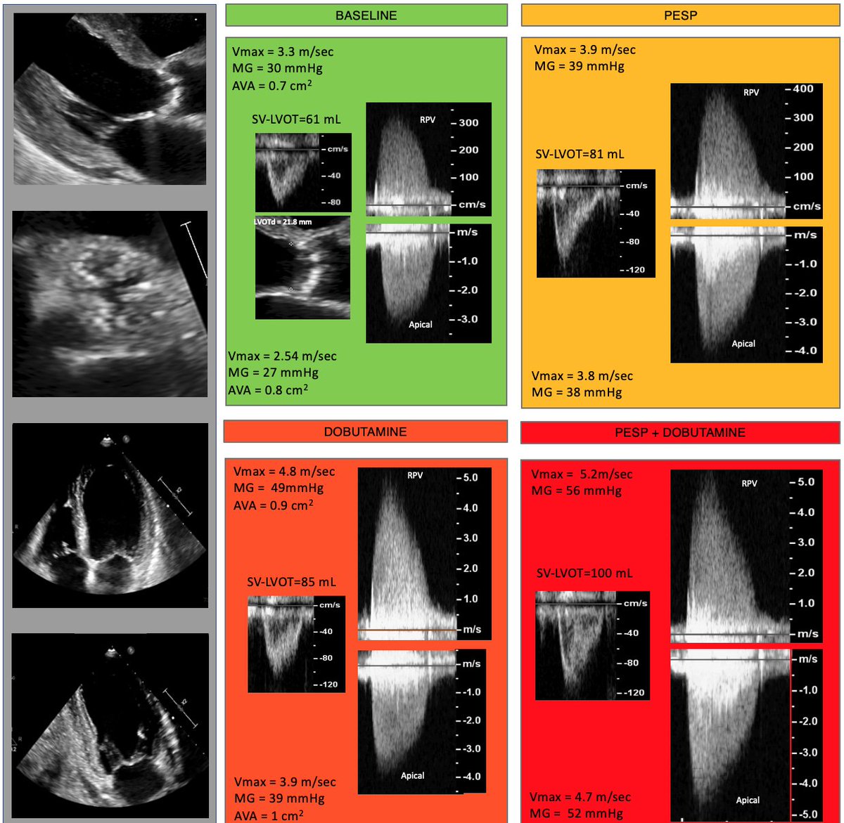 Giovanni Benfari (@giovannibenfari) on Twitter photo Do you ever tried the right-parasternal-approach during Dobutamine Stress Echo for low-gradient Aortic Valve Stenosis? <a href="/PPibarot/">Philippe Pibarot</a> <a href="/StefanoNistri/">Stefano Nistri ⬛️</a> <a href="/strain_rate/">🇳🇴🇩🇰Asbjørn Støylen 🇬🇱🇵🇸🇺🇦</a> <a href="/gavazzoni_mara/">MARA Gavazzoni</a> <a href="/DrGEMandoli/">Giulia Elena Mandoli, MD, PhD, FESC, FISC</a> onlinelibrary.wiley.com/doi/10.1111/ec… Do you ever tried the right-parasternal-approach during Dobutamine Stress Echo for low-gradient Aortic Valve Stenosis? <a href="/PPibarot/">Philippe Pibarot</a> <a href="/StefanoNistri/">Stefano Nistri ⬛️</a> <a href="/strain_rate/">🇳🇴🇩🇰Asbjørn Støylen 🇬🇱🇵🇸🇺🇦</a> <a href="/gavazzoni_mara/">MARA Gavazzoni</a> <a href="/DrGEMandoli/">Giulia Elena Mandoli, MD, PhD, FESC, FISC</a> onlinelibrary.wiley.com/doi/10.1111/ec…