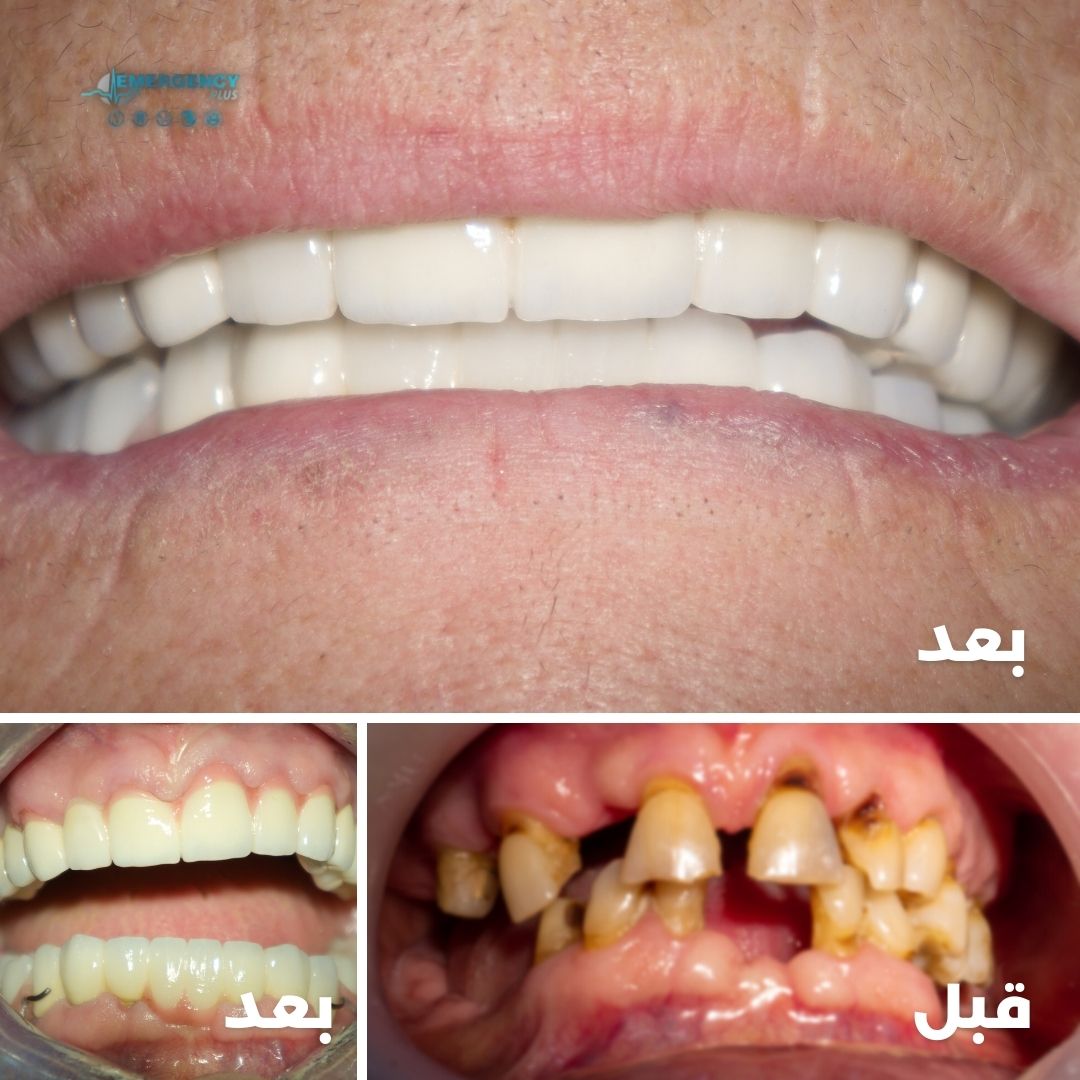 emergencyplus24's tweet photo. علاج فم كامل لسيدة سبعينية وتركيب جسرين ثابتين وجزئية متحركة الفك الأسفل من الخلف

#طبيب_أسنان #دكتور_أسنان #علاج_الاسنان #تركيبات_اسنان #جسور_اسنان #أسنان #emergencyplus https://t.co/CJV0qfOguT