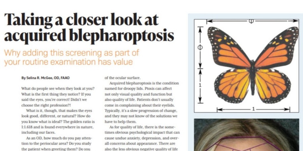 Taking A Closer Look At Acquired Blepharoptosis
By: Selina R. McGee, OD, FAAO
Optometry Times Journal, November digital edition 2021

Follow Link: ow.ly/bccG50Hjpby

<a href="/SelinaMcGee/">Selina McGee</a> 
<a href="/OptometryTimes/">Optometry Times</a> 
<a href="/RVLPharma/">RVL Pharma</a> 
#intrepideyesociety #ptosis  #upneeq