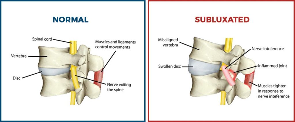 Subluxation is a term you may hear our doctors saying often in the office, but what does it mean? 

-A subluxation is a misalignment of the spine that puts pressure on nerves leading to pain and inflammation. #chiropractic #subluxation #boulder