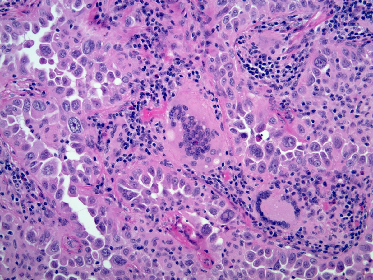 smlungpathguy's tweet photo. Ockamโs Razor or Hickamโs dictum? https://t.co/ihPI8GM5hZ