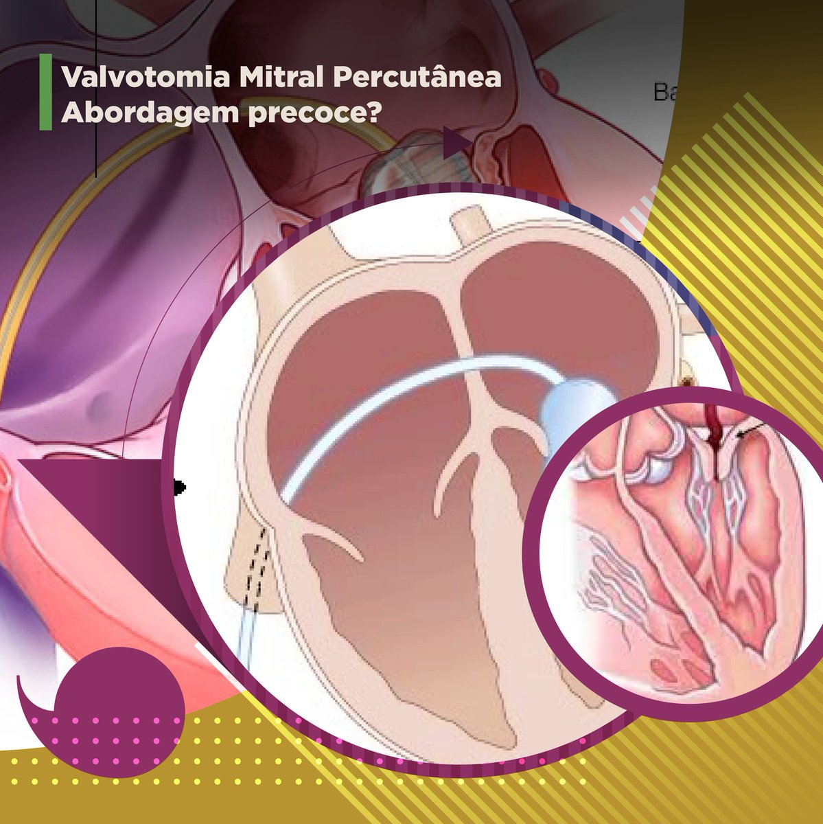We have recently seen a discussion of addressing asymptomatic aortic stenosis early on.
.
Could this approach be applied to mitral stenosis? Does it have a positive impact?
.
Go to thevalveclub.com.br