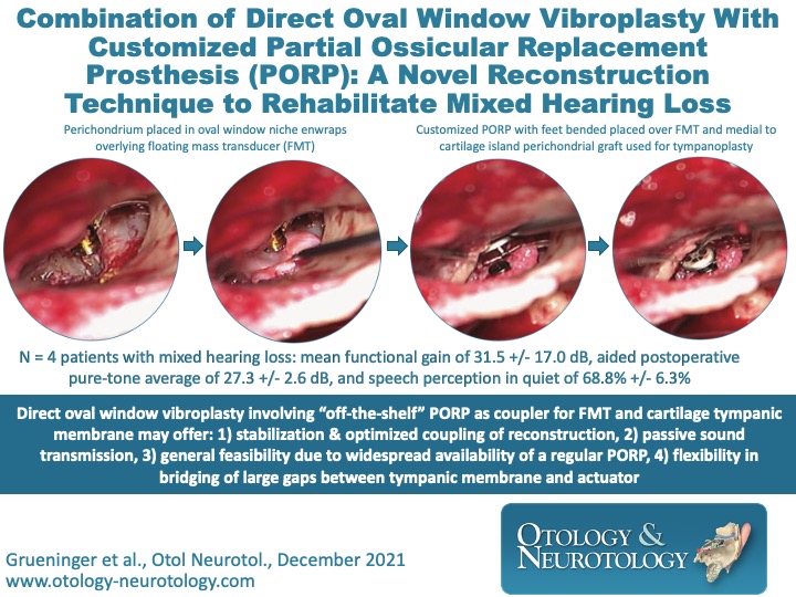 OandNonline's tweet photo. Novel technique combines active middle ear implant with partial ossicular placement prosthesis in patients with mixed hearing loss. https://t.co/AJB76RaBUM #AMEI #PORP #Ossiculoplasty https://t.co/Asj5iOfXqH