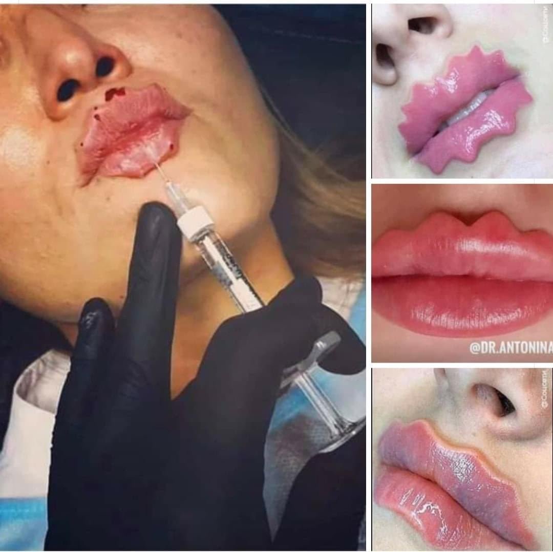 Wanneer fillers niet genoeg zijn