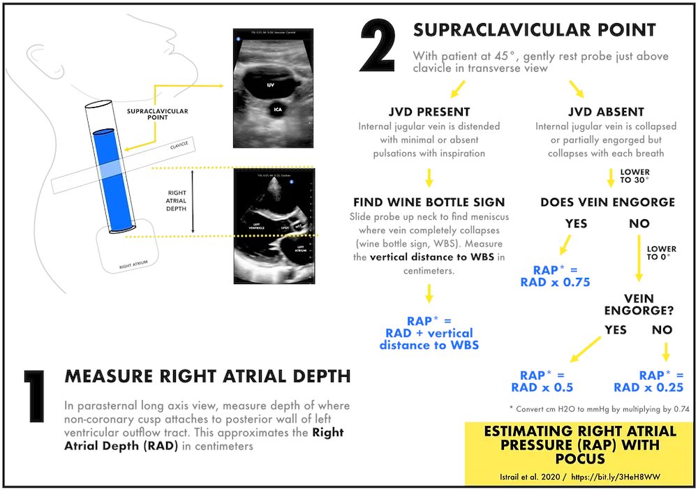 pocusmeded's tweet photo. The IVC is viewed by many as the gold standard for right sided pressures. It definitely shouldn't be. Our new post:
https://t.co/MtIJ5SKzAj

#POCUS  #impocus #FOAMed #MedEd #CardioTwitter https://t.co/DNHDBBOq4X