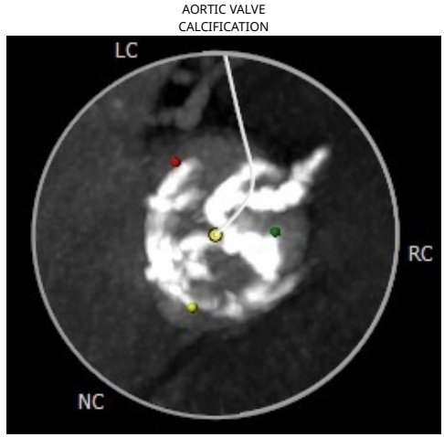 AlkashkariWail's tweet photo. 78♂️ severe AS MPG65,heavily calcified ++++ with mod to severe LVOT calcification. Annular perimeter 547. #medtronic evolute 34mm with #cusp_overlap #commisural_alignment. Final MPG6, sinus + no LBBB. Mild AI (after 23 🎈).. waited for 20mint the AI Trace on #echofirst https://t.co/kTeboLlDKC