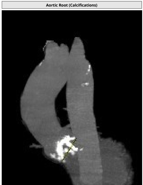 AlkashkariWail's tweet photo. 78♂️ severe AS MPG65,heavily calcified ++++ with mod to severe LVOT calcification. Annular perimeter 547. #medtronic evolute 34mm with #cusp_overlap #commisural_alignment. Final MPG6, sinus + no LBBB. Mild AI (after 23 🎈).. waited for 20mint the AI Trace on #echofirst https://t.co/kTeboLlDKC