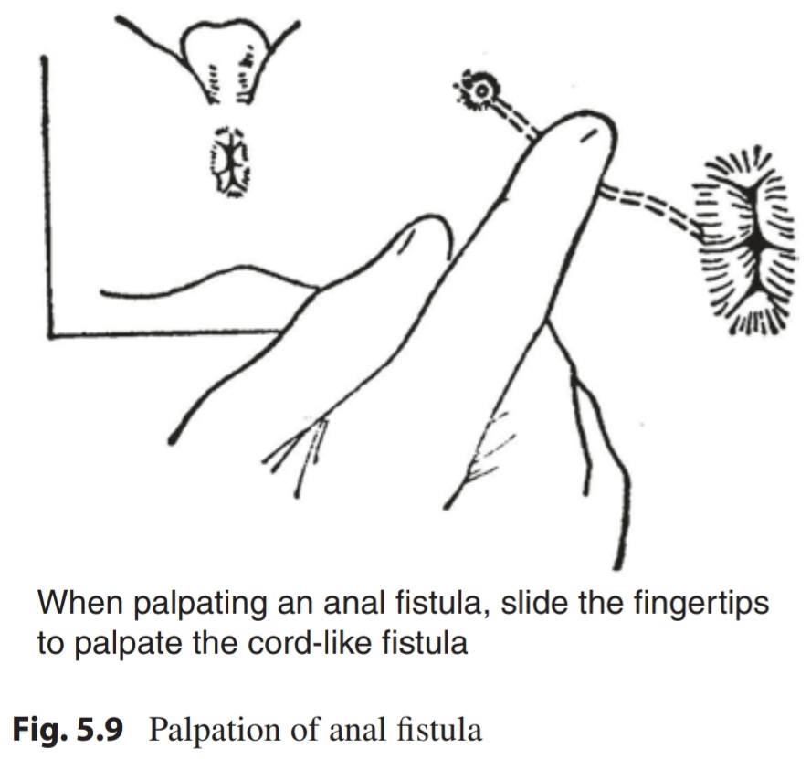 DR AFTAB AHMED on X: 𝗡𝗮𝘃𝗶𝗰𝘂𝗹𝗮𝗿 𝗮𝗿𝗲𝗮 (anal triangle) concept,  Class wise management of Pilonidal sinus, Approach algorithm for infected pilonidal  cyst & Main primary wound closures techniques in pilonidal cyst: Ref