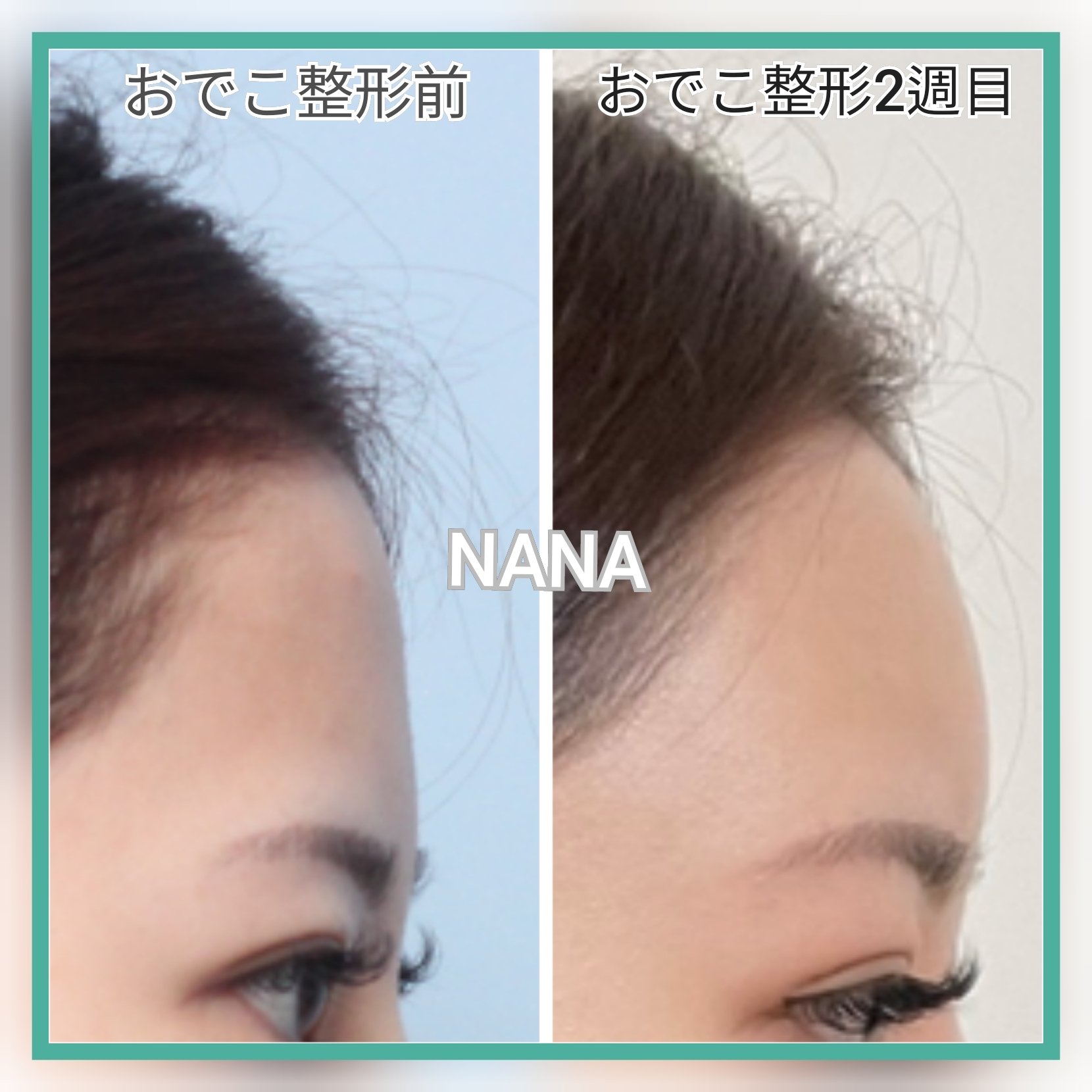おでこ整形 Twitter Search Twitter