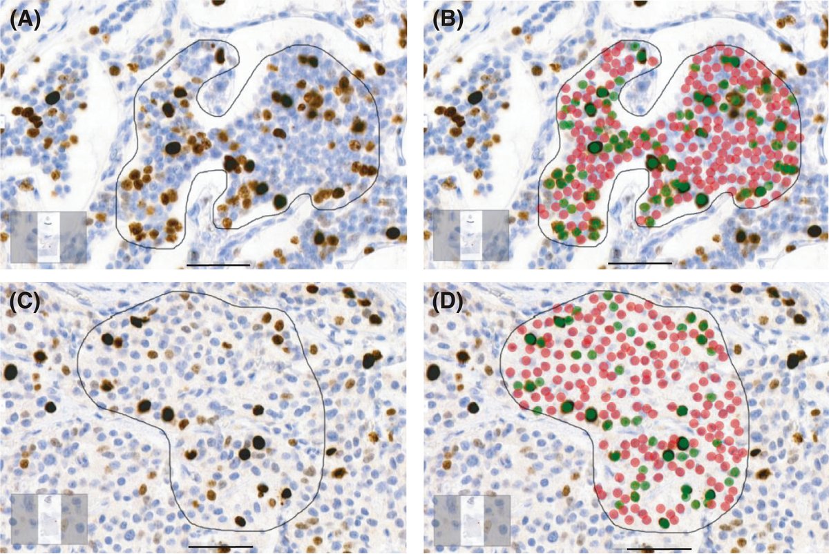 The #DeepLearning based Ki-67 proliferation index (PI) algorithm yields results similar to human observers. While the algorithm can't replace the #pathologist, it can assist in the laborious Ki-67 PI assessment of #neuroendocrine tumors bit.ly/3Fukb1D 
<a href="/TiinaVesterinen/">Tiina Vesterinen</a>