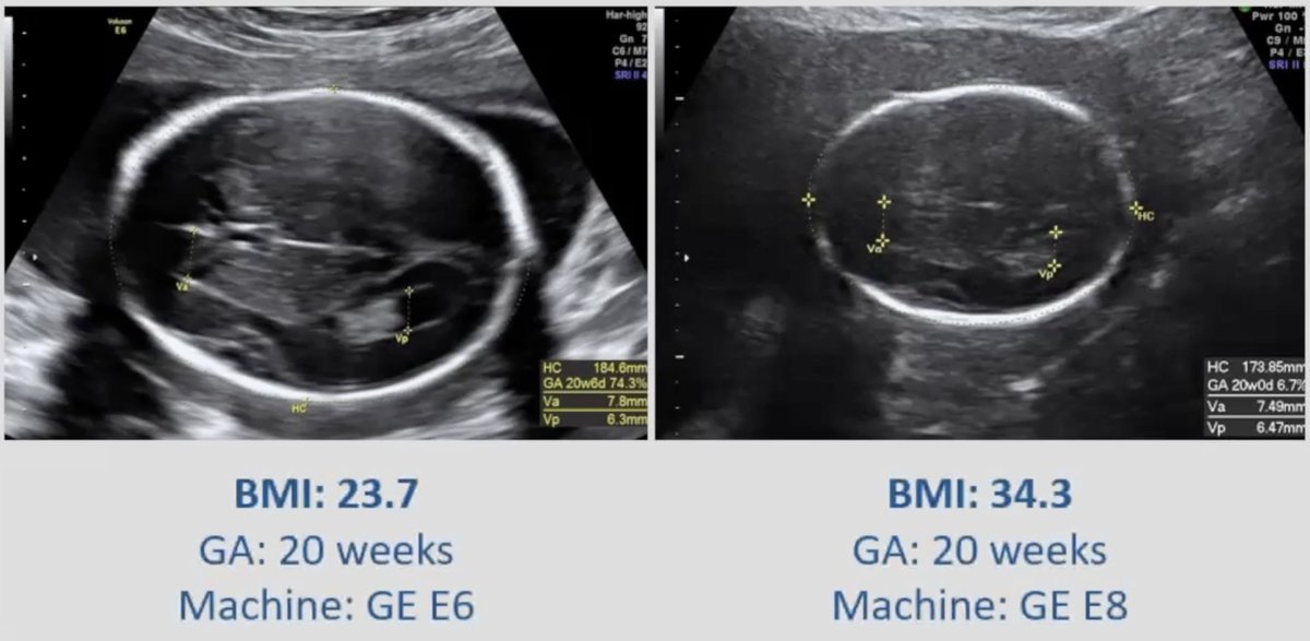 The effect of maternal body mass index on fetal ultrasound image quality ajog.org/article/S0002-… <a href="/acog/">ACOG</a> <a href="/ISUOG/">ISUOG</a> <a href="/RCObsGyn/">RoyalCollegeObsGyn</a> <a href="/AIUMultrasound/">AIUM Ultrasound</a> #ultrasound #quality #ObGyn