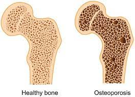 ThyroidTherapy's tweet photo. #Bone #Density Loss Similar in #Postmenopausal Black and White #Women
for more details:https://t.co/tmhVaKxm62 https://t.co/OvPyUniVrs