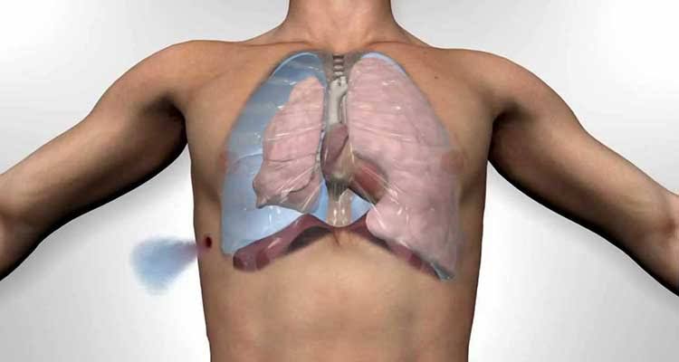 #Pnömotoraks ani gelişen ve hayatı tehdit edebilecek bir hastalıktır. Halk arasında akciğer sönmesi olarak bilinir.
-Göğüste, kürek kemiğinin altında ani başlayan şiddetli batma
-Ani başlayan nefes darlığı
-Baygınlık hissi

Belirtileri ortaya çıktığında acil müdahale gerektirir.