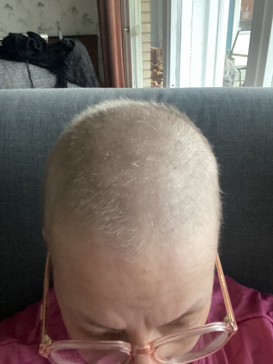 gnildron24's tweet photo. Äntligen lite hår, 5 månader sen det föll av pga cellgifter. #hår #cellgifter #cancer #myelom https://t.co/CYphLbviW3