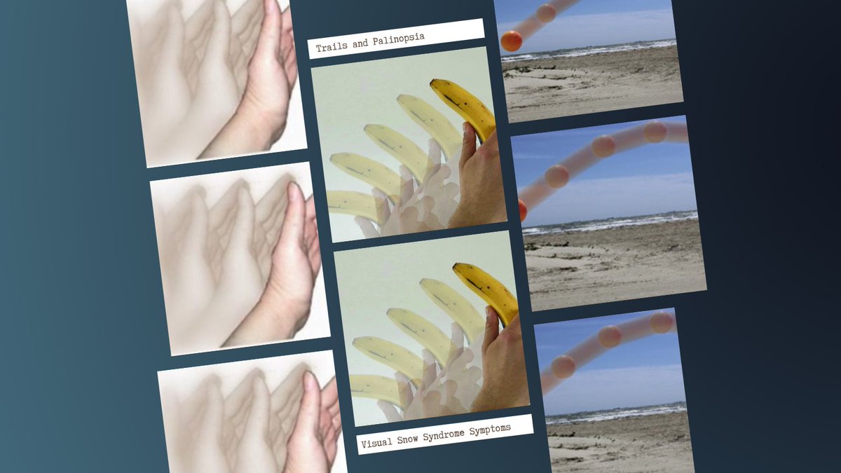 EyeOnVision's tweet photo. Wikipedia defines Illusory #palinopsia as visual #trailing of an object in motion leaving frozen copies in its wake. These motion-induced afterimages may be discontinuous such as in a film reel or may be blurred together such as in a long-exposure photograph. #visualsnowsyndrome https://t.co/aVC7SvIRud