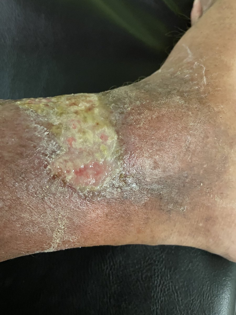 #20 COMPLETED! 

1 cancer treatment remains!

We’re almost home! 🙏🤠