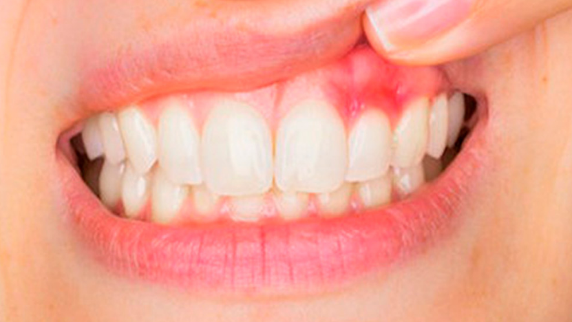 UshaDiamonds's tweet photo. Once the bacteria spread to the bones in periodontitis, irreversible changes can start to take place with the loss of attachment of the gums and bone loss. 
https://t.co/akpGEhxNZY https://t.co/CIDh6WyoaI