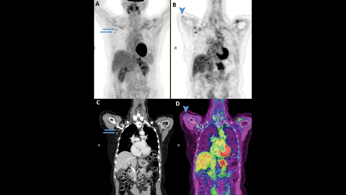 radiology_rsna's tweet photo. Check out our fourth most-read article of 2021, which highlights a potential pitfall of FDG PET/CT imaging after #COVID19 vaccination in patients with cancer. https://t.co/SAyH2QNPIH https://t.co/R4p8l0Rmes