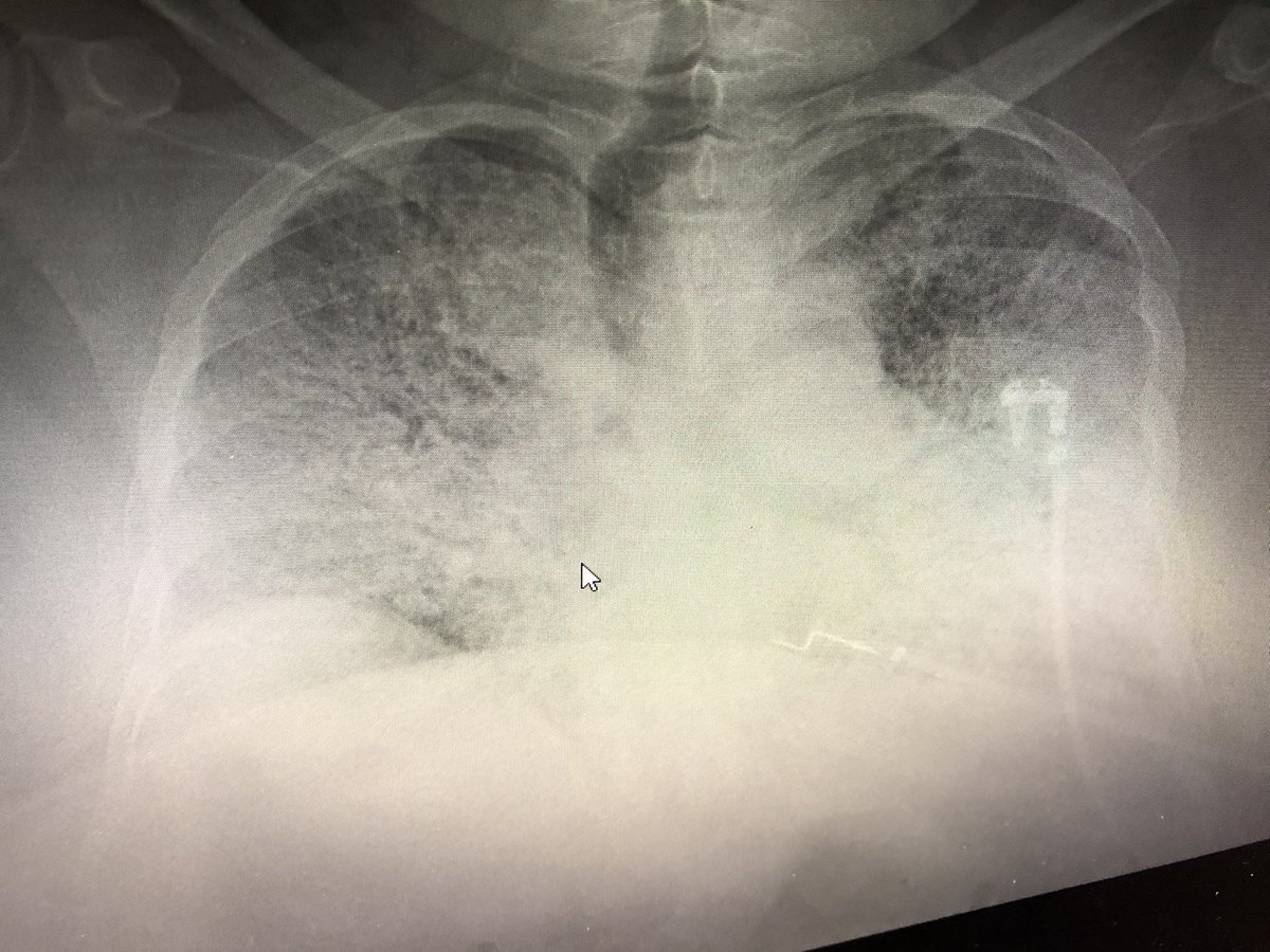 Having to keep pts on BIPAP at 100% FiO2 and this CXR on the wards because there are no ICU beds is not optimal…

#MedTwitter 
#Omicron