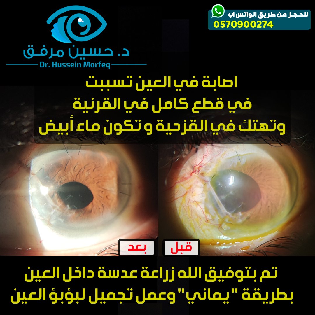 نصيحة من طبيب عيون: احرصوا على لبس نظارة الوقاية/الحماية اثناء عمل أعمالكم اليدوية باستخدام أدوات حادة لتجنب حدوث اصابات في العين. حمانا الله و أياكم

#وقاية 
#عيون 
#نصيحة 
#اصابة 
#فضفضة_طبيب
 <a href="/6abeb_/">#صوت_الطبيب🩺</a> 
#جدة_الأن