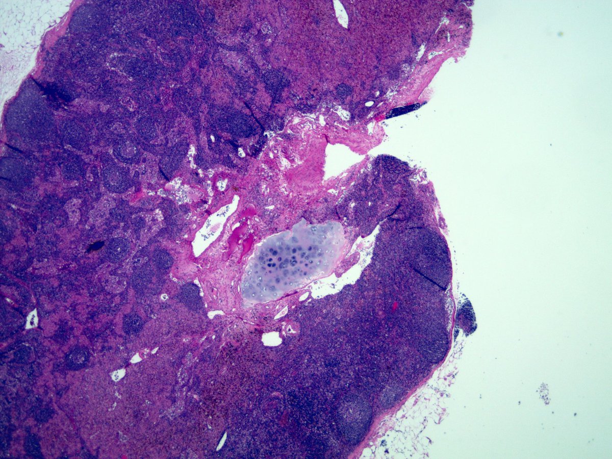 smlungpathguy's tweet photo. Ah @lara_pijuan your entity appeared again, this time in level 7 #laraslesion #ebustwitter https://t.co/XqtIKgyMl7