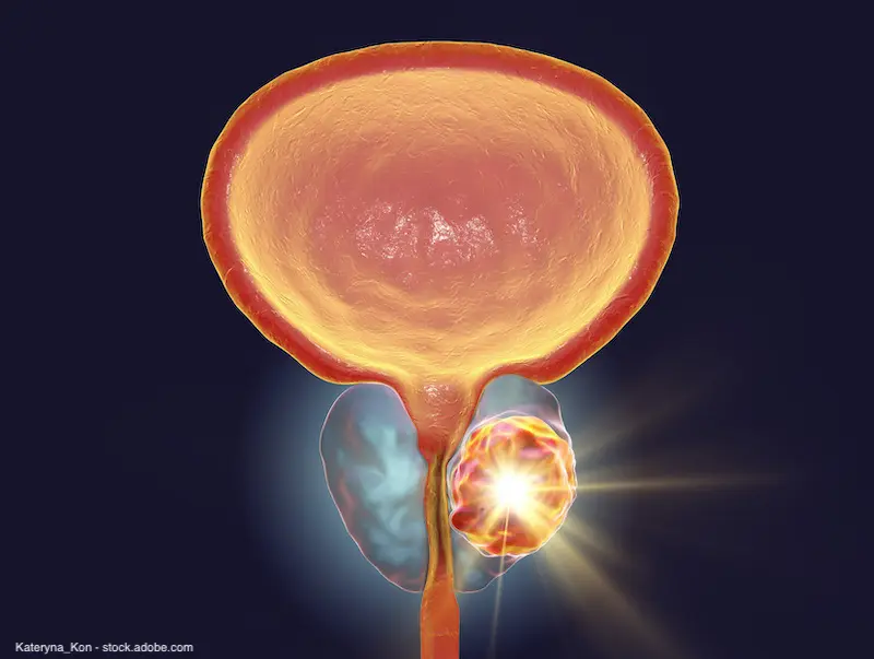 OfAdvances's tweet photo. Adverse pathology predicts metastasis, death in patients with prostate cancer https://t.co/ZPn50vzW7b via @urologytimes 
#Alsb https://t.co/HjR71V32ZK