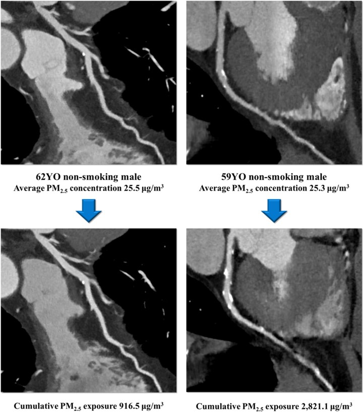 journalCCT's tweet photo. An observational retrospective cohort study by Lee et al. demonstrated cumulative exposure to air pollution was 
associated with progression of diffuse coronary calcification on #yesCCT in an analysis of 3,127 participants.  
https://t.co/02KF9ORs0b https://t.co/XAkVtiwMgh