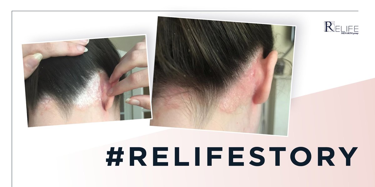 RELIFEIrl's tweet photo. Having lived with psoriasis for over half her life, pharmacy store manager Laura Halloran has tried countless products without success. RELIFE’s U-Life 10 ecofoam has impressed her. Read her RELIFEStory in the latest issue of Skin Conscious magazine. https://t.co/kpupJ2fmzL https://t.co/B1OLIwzFZQ
