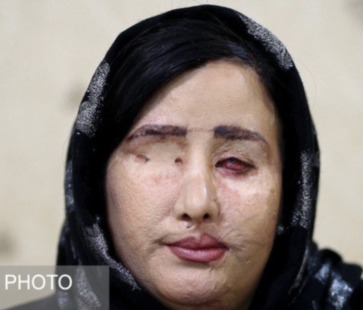 AlinejadMasih's tweet photo. In my beloved county Iran, these two women, Soheila and Marziyeh, were subjected to acid attacks for not wearing “proper hijab”. They still have to wear hijab if not they will get jailed or lashes. In the West I’m told, sharing their stories will cause Islamophobia. 
#LetUsTalk https://t.co/SHc8MX9R0a