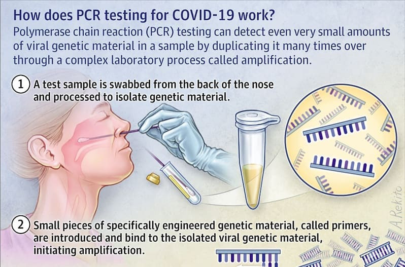 Test de lactulosa para sobrecrecimiento bacteriano