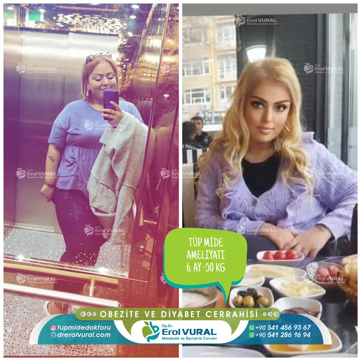 Obezite Cerrahisi ile 6 ayda -50kg kayıp.
Op. Dr. Erol Vural ve ekibi ile hizmetinizdeyiz.
📲+90 541 456 93 67 #mideküçültme #kiloverme #tüpmide #drerolvural #obezite #fypシ #obezitetedavisi #sleevegastrectomy