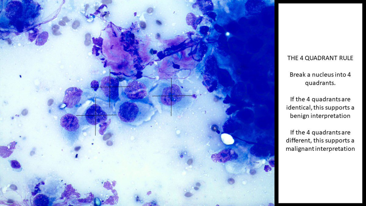 smlungpathguy's tweet photo. #cytopath #pathology #pulmpath https://t.co/QzvtcWreRn