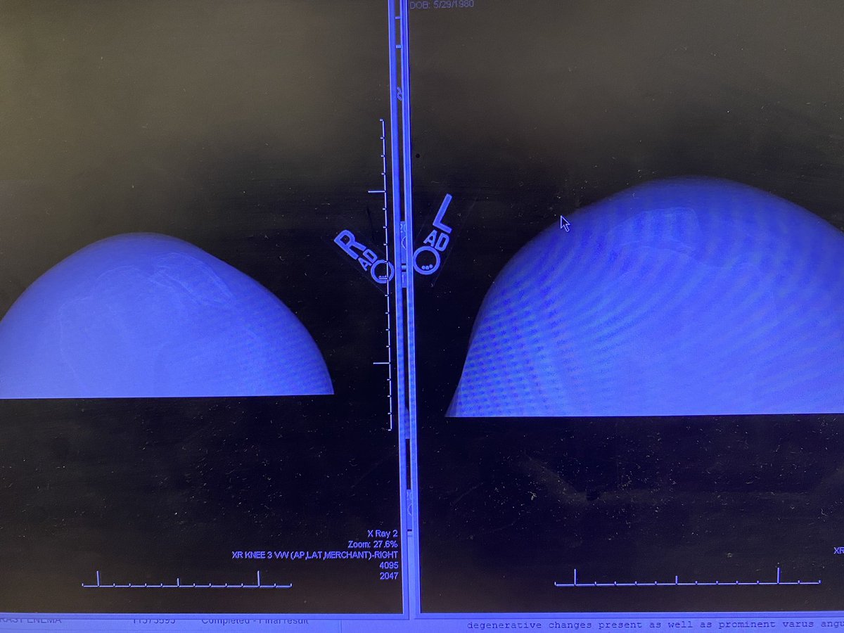 Craig Hogan (@hoganmdcraig) on Twitter photo Would love to get thoughts on this case. 41y/o female from Nigeria. Bilateral knee pain and previous surgeries. Skin very thin and tenuous. #orthotwitter <a href="/jointdocShields/">John Shields, MD, FAAOS</a> <a href="/DrLeeRubin/">Lee E. Rubin, M.D., FAAOS, FAAHKS, FAOA</a> @BoneDocMMD <a href="/CoryCalendineMD/">Cory Calendine, M.D.</a> <a href="/_NancyMD/">Nancy “NancyMD” Yen Shipley, MD, FAAOS</a> <a href="/rkh_md/">Ryan K Harrison, MD</a> <a href="/Dr_Stambough/">Jeff Stambough, MD, FAAOS</a> and everyone else Would love to get thoughts on this case. 41y/o female from Nigeria. Bilateral knee pain and previous surgeries. Skin very thin and tenuous. #orthotwitter <a href="/jointdocShields/">John Shields, MD, FAAOS</a> <a href="/DrLeeRubin/">Lee E. Rubin, M.D., FAAOS, FAAHKS, FAOA</a> @BoneDocMMD <a href="/CoryCalendineMD/">Cory Calendine, M.D.</a> <a href="/_NancyMD/">Nancy “NancyMD” Yen Shipley, MD, FAAOS</a> <a href="/rkh_md/">Ryan K Harrison, MD</a> <a href="/Dr_Stambough/">Jeff Stambough, MD, FAAOS</a> and everyone else