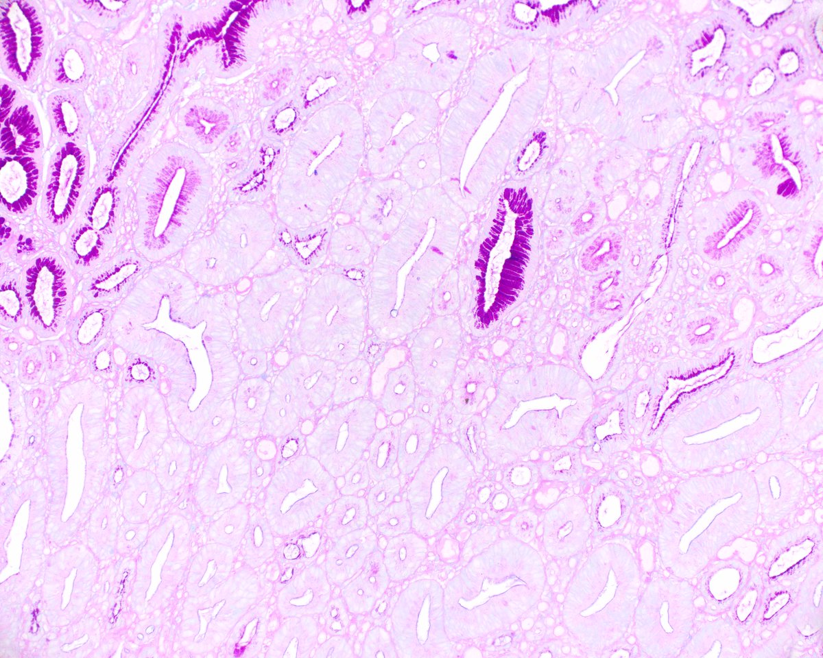 LizMontgomeryMD's tweet photo. This antral hyperplastic polyp has an area of high grade dysplasia.  However, since the surface was eroded I was a little nervous, so I tried the PAS/AB trick that that we had noticed, and it seemed to help!  
 Histopathology. 2021 Feb;78(3):453-458. PMID: 32841414. https://t.co/7fIFGKWwAP