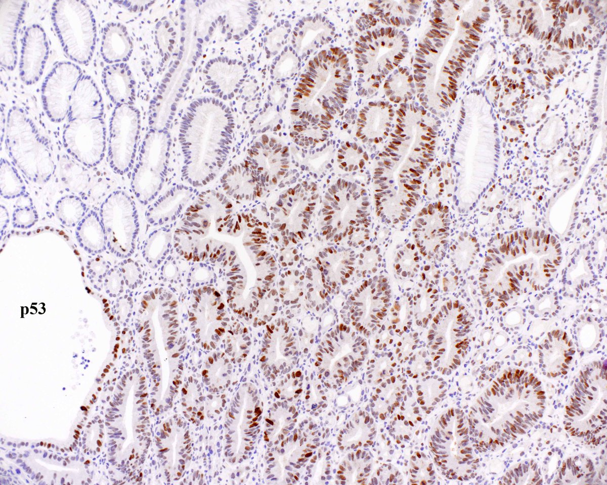 This antral hyperplastic polyp has an area of high grade dysplasia.  However, since the surface was eroded I was a little nervous, so I tried the PAS/AB trick that that we had noticed, and it seemed to help!  
 Histopathology. 2021 Feb;78(3):453-458. PMID: 32841414.