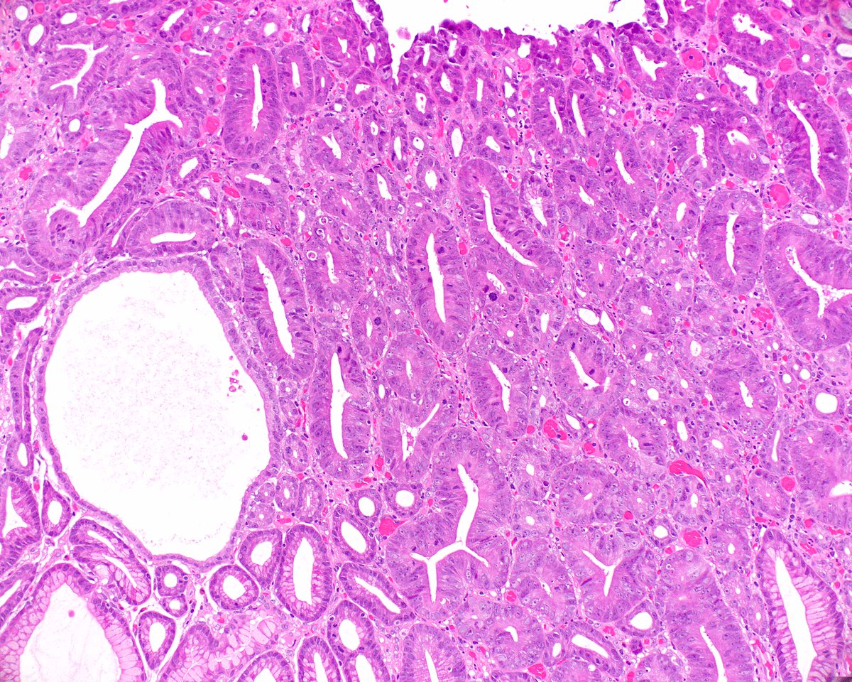 LizMontgomeryMD's tweet photo. This antral hyperplastic polyp has an area of high grade dysplasia.  However, since the surface was eroded I was a little nervous, so I tried the PAS/AB trick that that we had noticed, and it seemed to help!  
 Histopathology. 2021 Feb;78(3):453-458. PMID: 32841414. https://t.co/7fIFGKWwAP