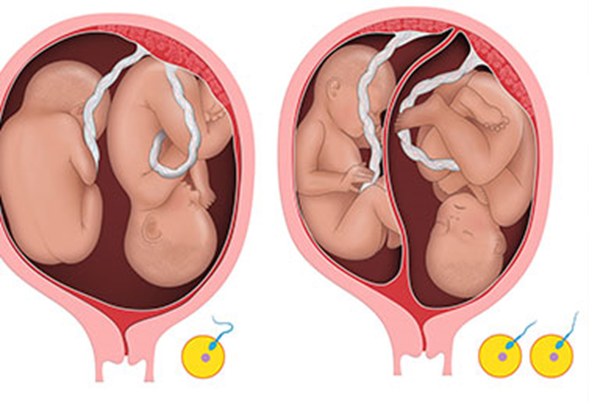AOGS_tweets's tweet photo. Even though the perinatal mortality of Finnish #twins is low, #monochorionic twins are at higher risk of perinatal morbidity and mortality. Twin B faces more complications irrespective of #chorionicity and this difference could and should be narrowed.
https://t.co/kzr2y7x99R https://t.co/RZU9Nyfq0U