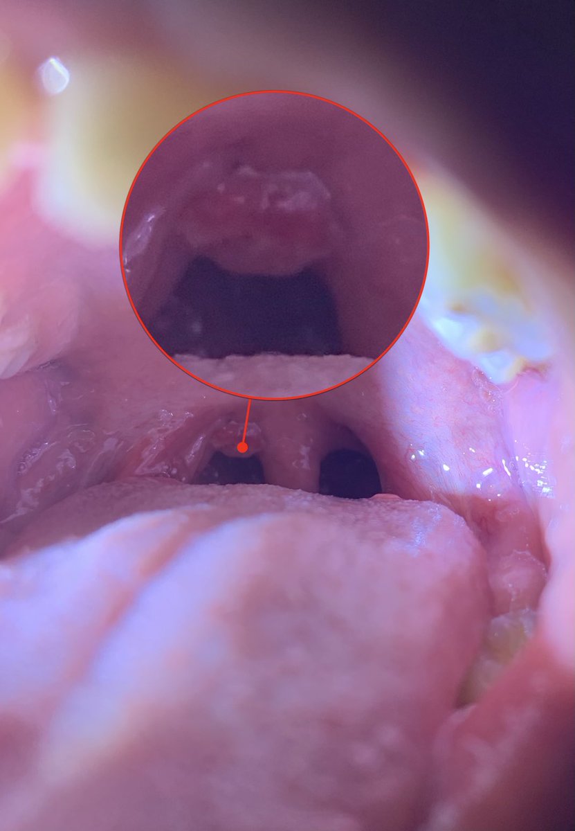 zola_mzimba's tweet photo. My youngest was complaining of a sore throat. Now I’m no ENT specialist but I looked in and saw these polyploid lesions next to his uvula. Panicked for a second then remembered he’s had multiple lateral flows recently. I can’t be the only person to have seen this surely https://t.co/c63GhNoKyB