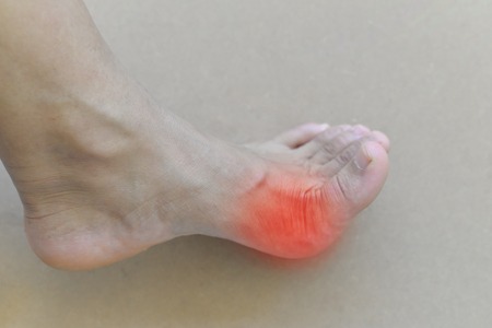 DPMPatrick's tweet photo. What is Gout, and why does this painful foot condition occur? Dr. Fettinger has helpful information for you, https://t.co/VNq7Hw6mUD

#PatrickFettingerDPMLLC #NewFairfieldCTfootdoctor #MiddleburyCTfootdoctor https://t.co/WbButfSNAq