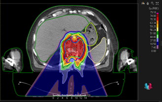 Robust planning safe and good? Michiel Kroesen &amp; co-authors describe that it's possible in chordomas and chondrosarcomas of spine or sacrum, and possibly a safer way of planning in order to both properly irradiate the target area and better spare organs. 
ow.ly/sYcF50HtA6B