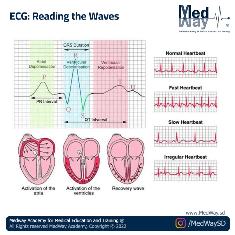 MedWaysd's tweet photo. ECG Reading the Waves💡
. 

• #ECG #anatomy #Cardio #heartbeat #medway #sudan #medicine #lecture #live #education #medwaysd #learn #ksa #uae #saudi #dubai #teaching #epilepsy #academic https://t.co/q3TD7r5uNJ