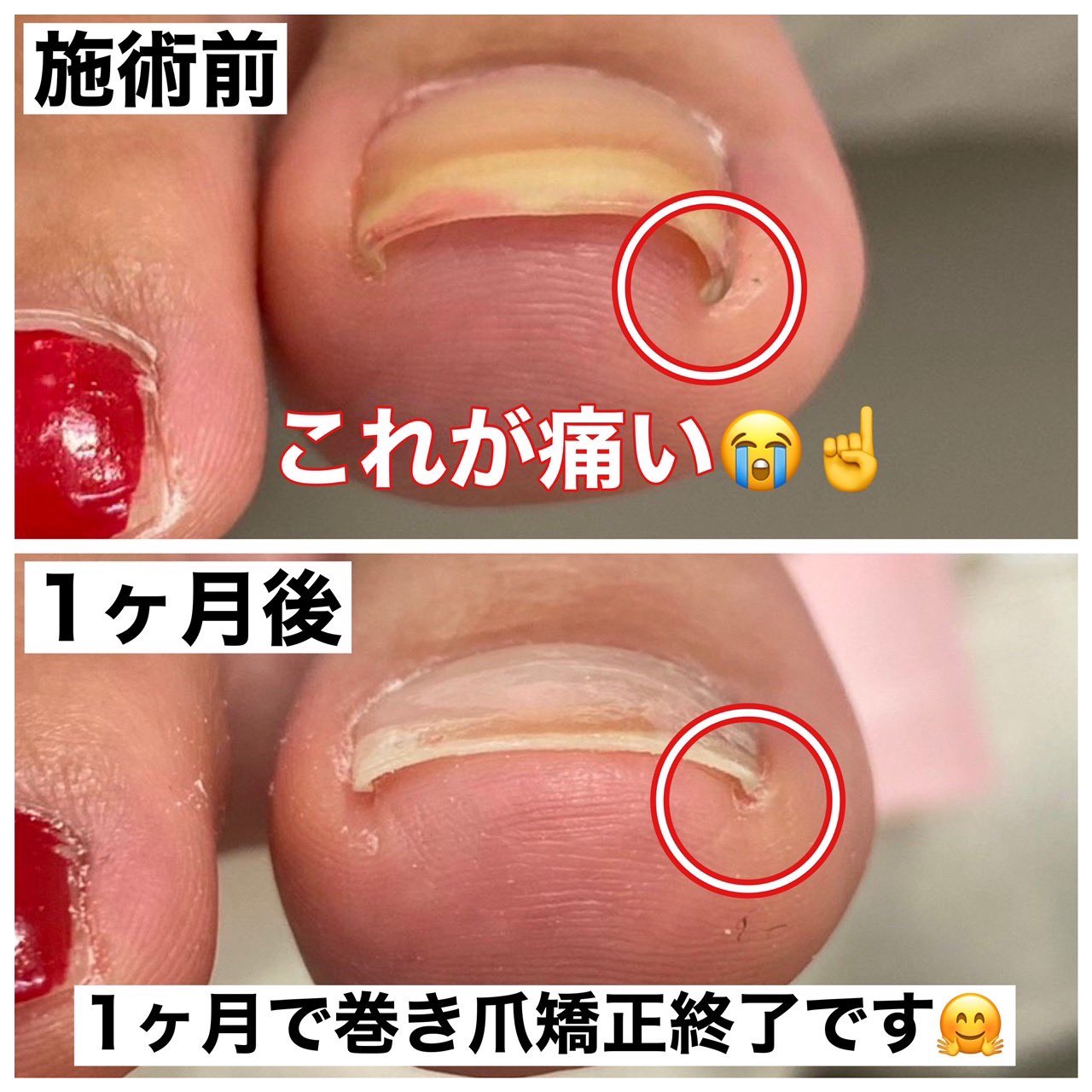 巻き爪サロン Libre 痛い箇所を切ったり 長く爪を伸ばすことにより痛みを誤魔化してきた巻き爪 ついに 歩くだけで激痛 レベルになり本格的に巻き爪治療をスタートされました 軽度の巻き爪の為1ヶ月で矯正終了しました 巻き爪 痛くない 巻き爪