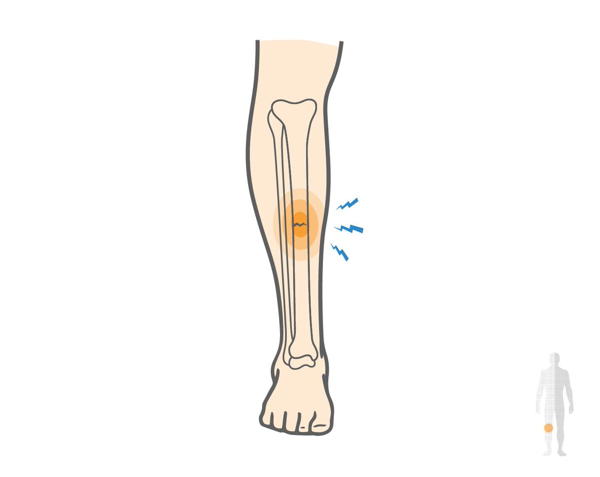 Трещина кости на ноге