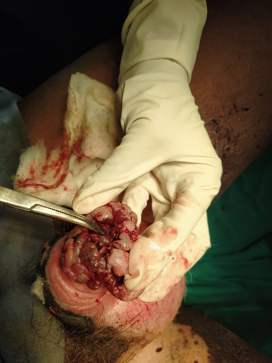DrMahparaK's tweet photo. #Carcinomapenis #Surgery #Surgeryposting https://t.co/r7A2nhmq27