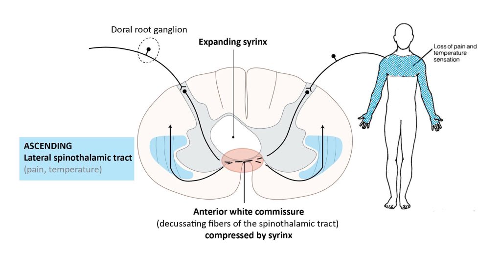 Commissore Drop Anterior White Commissure