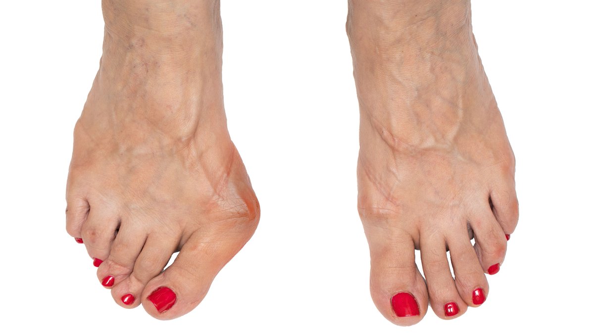 Bunions are perhaps the most common of all potential foot deformities. Dr. Matt Wettstein treats many of his patients with this condition and he can help you too! idahofoot.com/practice_areas…