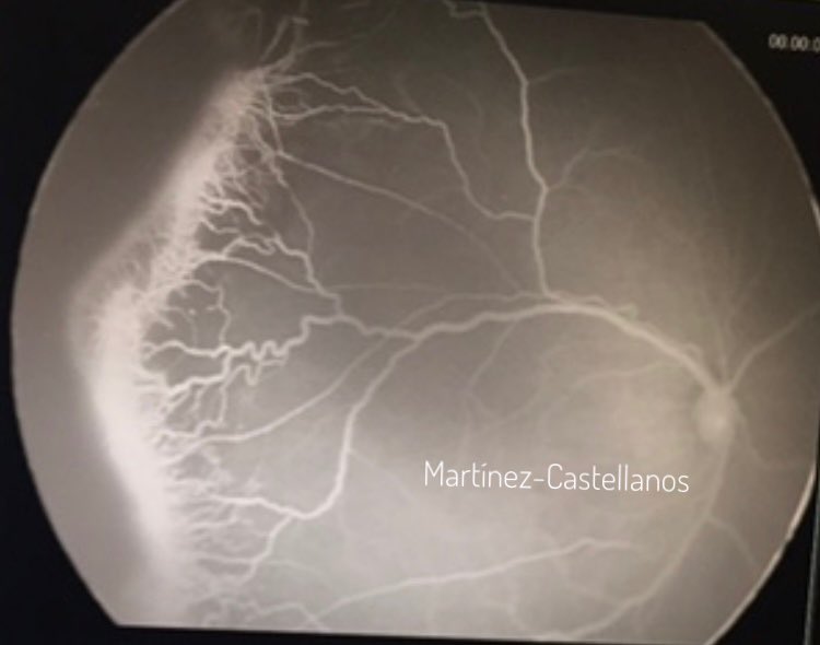 Esta es una angiografía de la retina de un bebé prematuro. Se ve donde se interrumpe la circulación, los vasos congestivos, la fuga de la fluoresceína en la línea de demarcación. Con una inyección de 0.01cc de antiangiogénico tiene 98% de posibilidades de tener visión normal